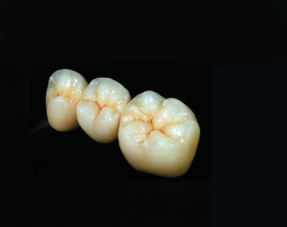 E max вкладка. Zirconia Crowns. Emax mo0. Керамическая коронка «Ivoclar e.Max».