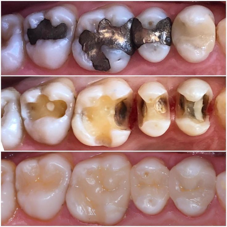 Amalgam Filling Replacement Guide Safe Amalgam Removal