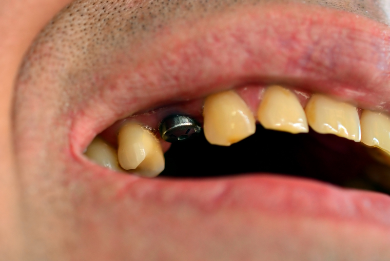 can-a-dental-implant-infection-mean-you-lose-your-implant