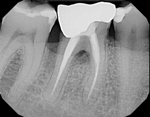 Root Canal Failure 2023 - How Can Root Canal Treatment Fail?