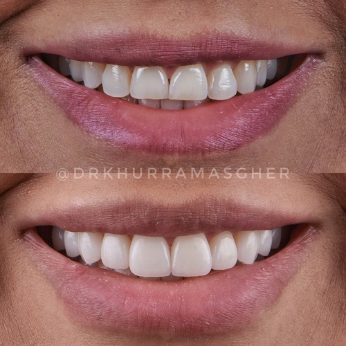 temporary-veneers-in-2023-will-they-look-good-or-look-bad